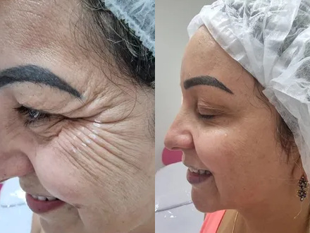 Comparativo de Botox na região dos olhos, publicado pela Cristal Estética