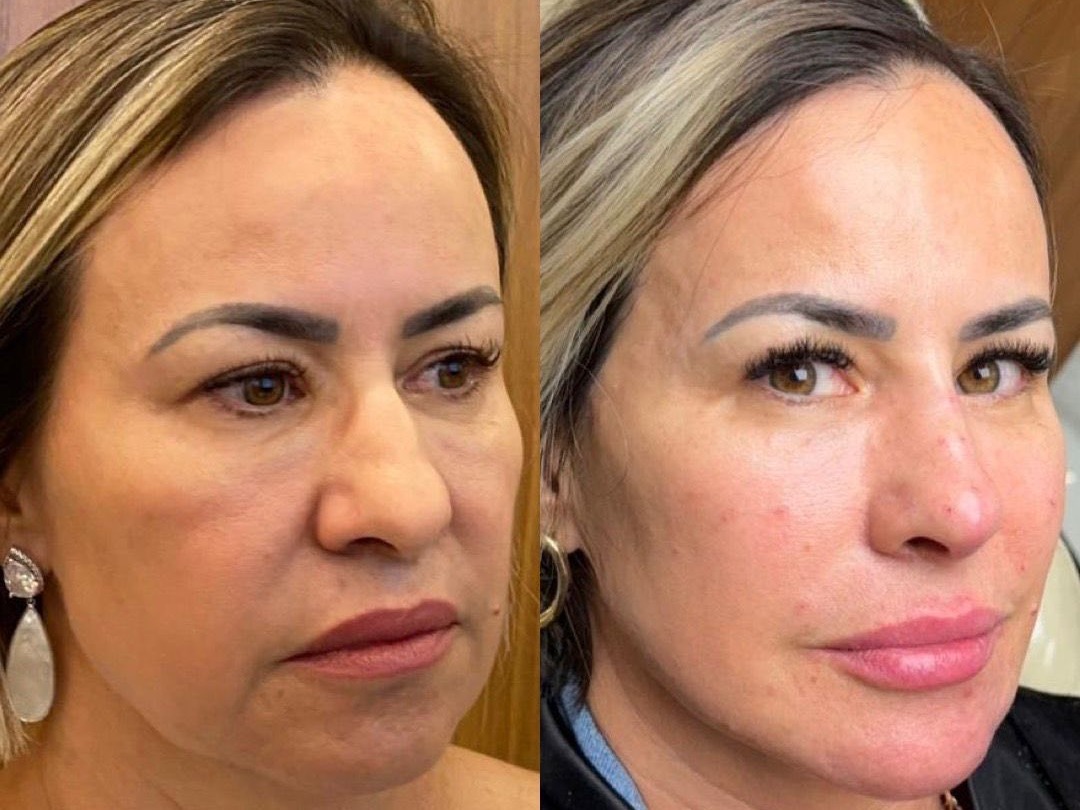 Comparativo real de harmonização facial