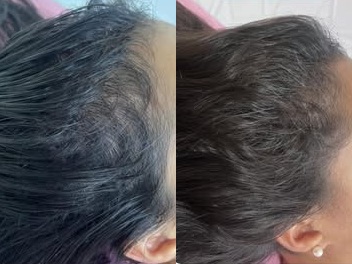 Antes e depois de estímulo capilar com Lavieen, publicado pela Cristal Estética