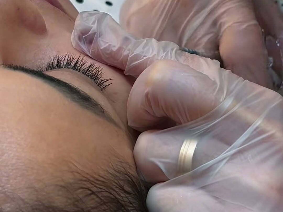 Extração manual durante limpeza de pele, publicada pela Cristal Estética