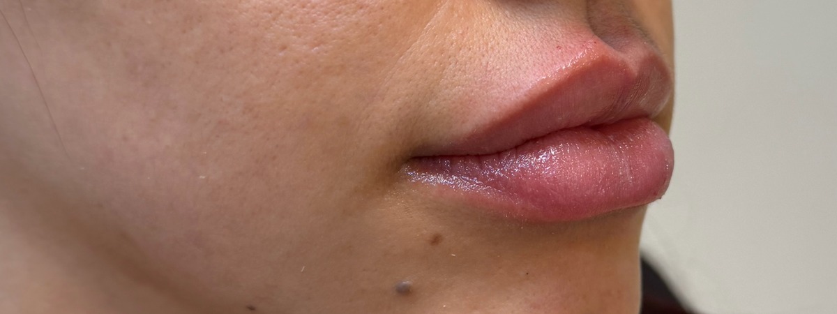 Depois do preenchimento labial