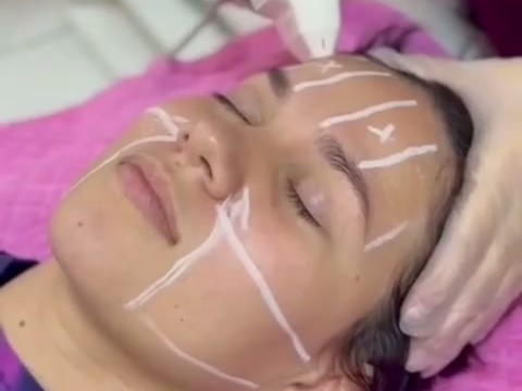 Cliente em atendimento com Ultraformer MPT na Cristal Estética